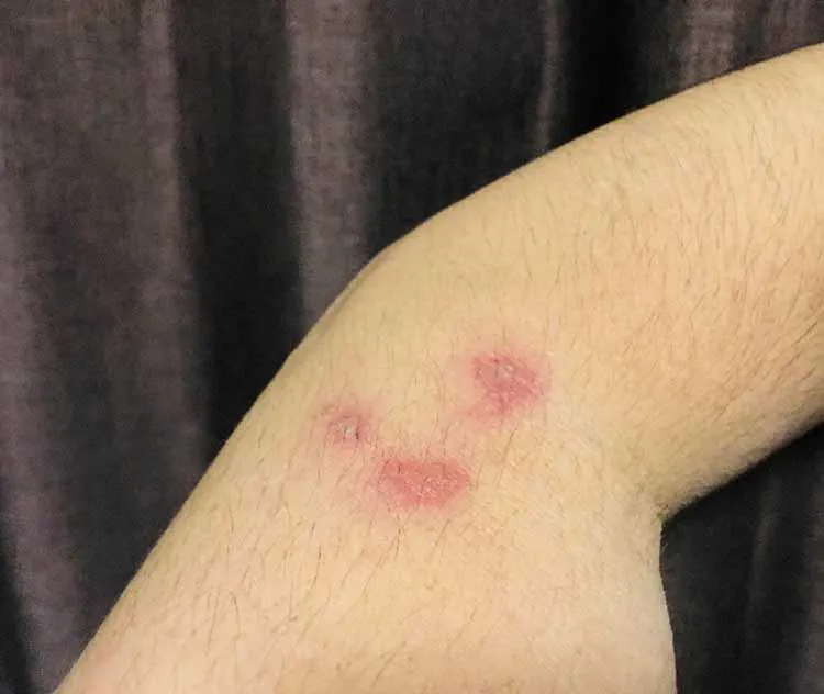 山林に潜む最凶の毒虫は アウトドアで虫刺され かゆい 腫れる 絶対に刺されてはいけない虫4選 テレ東プラス 山林に潜む最凶の毒虫は アウトドアで虫刺され かゆい 腫れる 絶対に刺されてはいけない虫4選 テレ東プラス